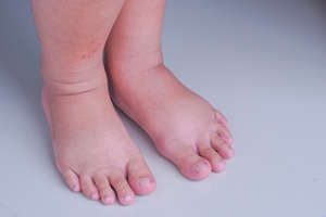 Changes in Your Toes May Signal Health Problems