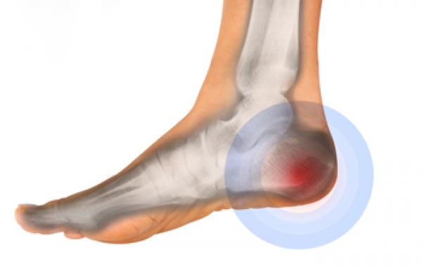 Pain on Bottom of Heel: Faulty Shock Absorption - Damien Howell PT