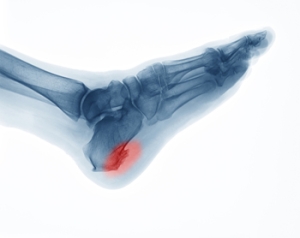 Possible Relief Methods for Heel Spurs