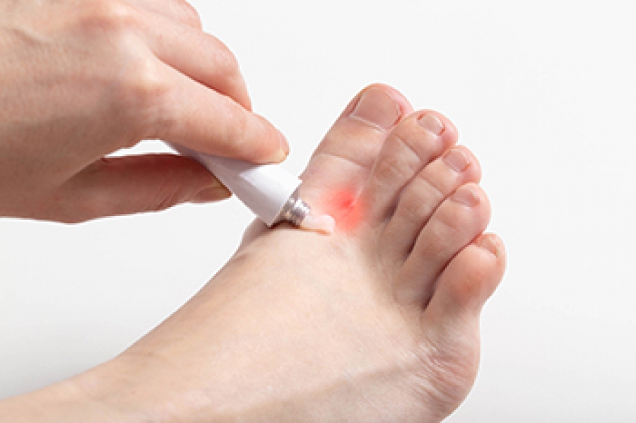 Athlete's foot - Symptoms, Causes, and Treatment – TRIHARD